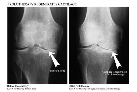 knee_x-ray.jpg